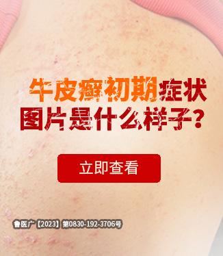 牛皮癬初期癥狀圖片是什么樣子？