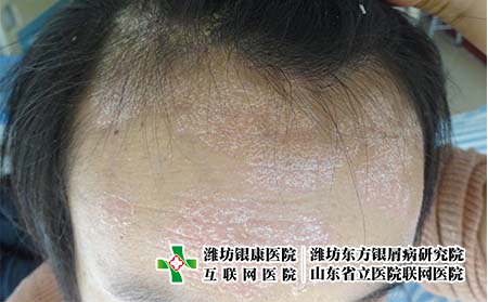 [銀屑病治療都詢濟南]怎么做才能夠有效預(yù)防牛皮癬