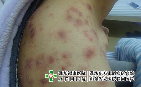 [銀屑病治療都詢濟南]怎么做才能夠有效預(yù)防牛皮癬