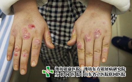 濟南牛皮癬專科研究院:銀屑病有什么危害