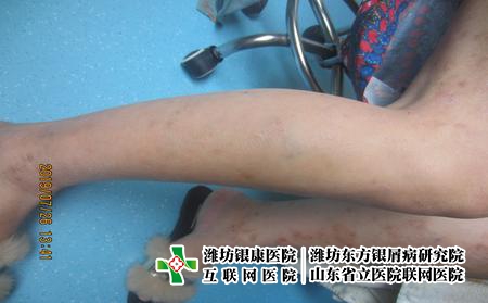 濟南兒童牛皮癬冬季需注意事項，冬天牛皮癬要注意什么