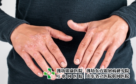 攝圖網(wǎng)_506227449_患有粗俗的牛皮癬濕疹和其他皮膚病（企業(yè)商用）_副本