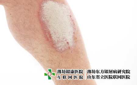 攝圖網_321241050_小腿上的牛皮癬或牛皮癬-特寫（企業商用）