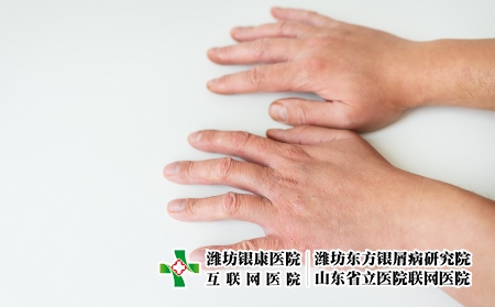 攝圖網_327119749_治療皮膚病 ??? 濕疹 皮炎 素質 在人的手上 皮膚病學方向的醫學理念和治療（企業商用）