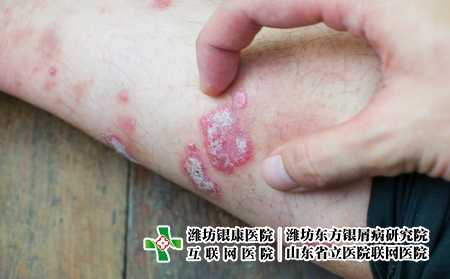攝圖網_323551465_絲蟲病藥品手臂皮炎宏觀彎頭疾病剝皮醫療衛生身體（企業商用）