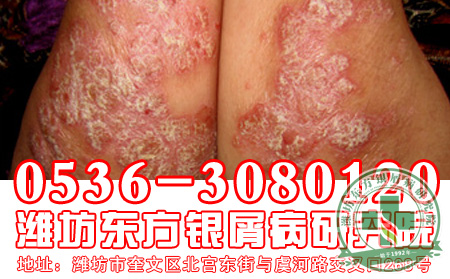 醫生提醒子女們：關愛老年牛皮癬患者