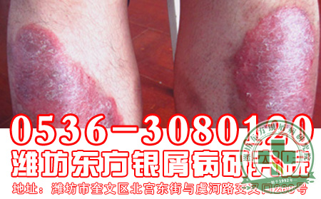 醫生講述：為什么那么多牛皮癬患者親睞中醫治療