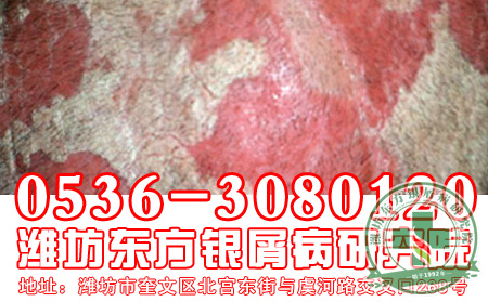 牛皮癬會不會致命呢？