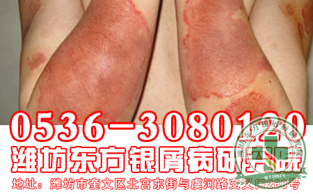 牛皮癬患者如何治療