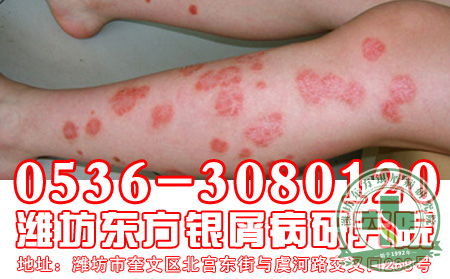 手術理想治療牛皮癬嗎