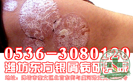 牛皮癬不是癬