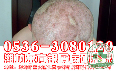 牛皮癬患者秋季護(hù)理如何進(jìn)行