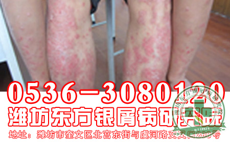 懷孕階段的女性得了牛皮癬怎么辦