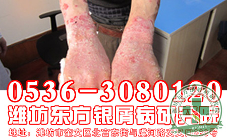 牛皮癬能治理想嗎