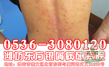 牛皮癬治療難嗎