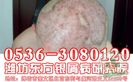 頭上有牛皮癬，理想經(jīng)常洗頭發(fā)嗎