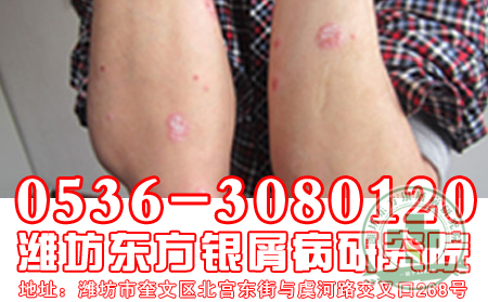 燙傷會導致牛皮癬復發？