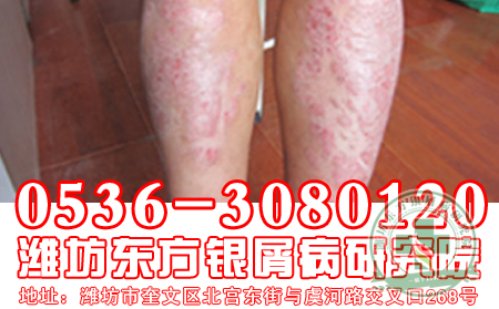 牛皮癬患者理想用花露水嗎