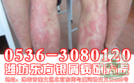 牛皮癬患者小心兩種人