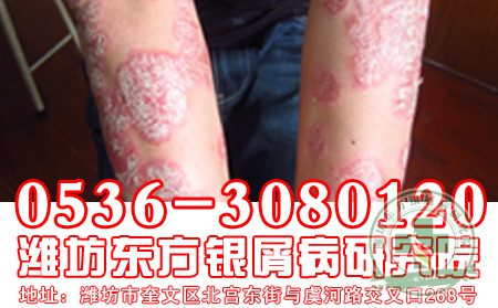 牛皮癬患者警惕“夏老虎”