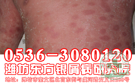 哪種居住環境易患牛皮癬