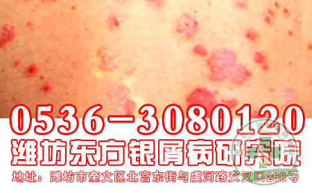 醫生提醒  牛皮癬治療要適度