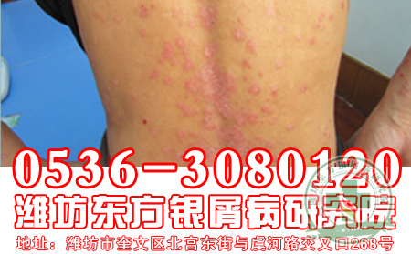回顧每次恢復牛皮癬患者