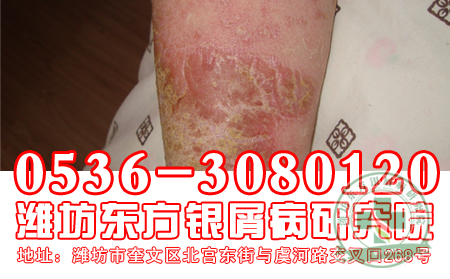 預防牛皮癬復發首位目標“長期治理想”