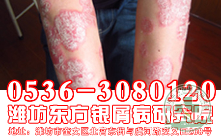 食鹽過多牛皮癬恢復的重大要害嗎?