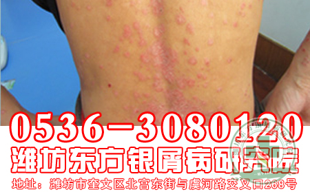 夏季得了牛皮癬真愁人