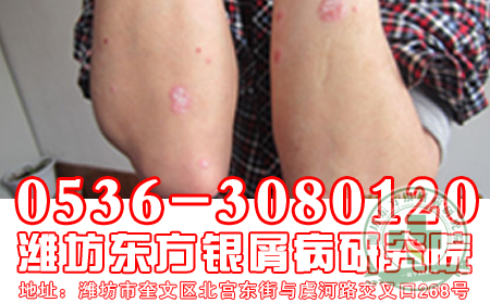 牛皮癬患者在補充營養的時候是否可使用魚