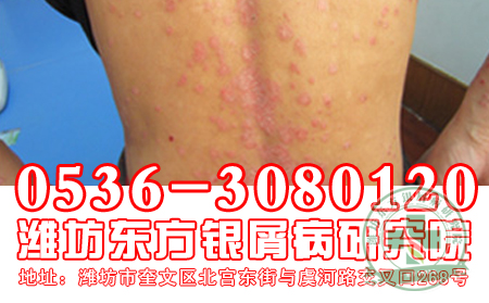 夏季牛皮癬治療 佳時期