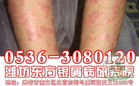 蛋白質是牛皮癬患者營養主食來源有哪些