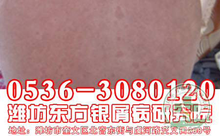 牛皮癬患者洗澡“四大”絕招