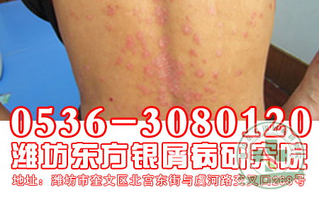 脂溢性牛皮癬患者生活中常見癥狀