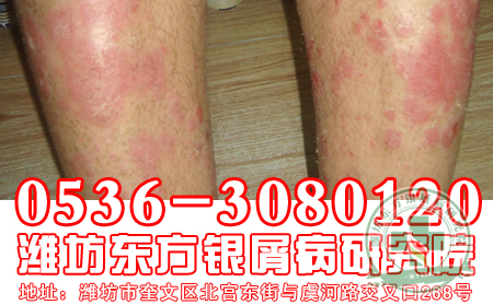 傳染會不會是導致銀屑病發病的誘因?