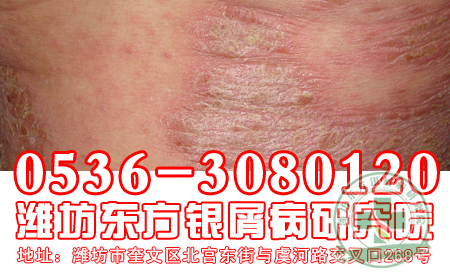 造成銀屑病患者發病的誘因有哪些?