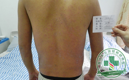 牛皮癬患者秋季如何抗感冒