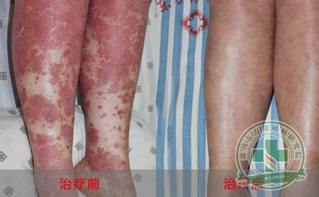 濟南銀屑病醫院醫生訪談:青少年牛皮癬患者存在的誤區