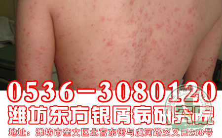 牛皮癬的治療方法