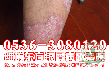 尋常型牛皮癬癥狀特點