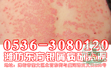 牛皮癬護理