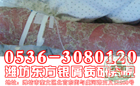 紅皮型牛皮癬的癥狀