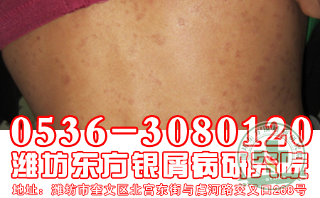 女性牛皮癬的癥狀