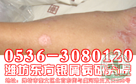 牛皮癬的常見癥狀