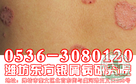 牛皮癬患者能吃什么不能吃什么