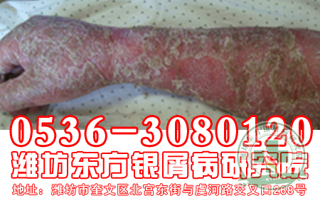 如何做理想牛皮癬預防工作