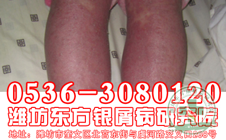 情緒低落會(huì)影響牛皮癬病情