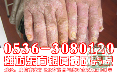 老年人要如何治療牛皮癬？