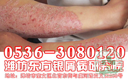 引起牛皮癬發作的原因有哪些？